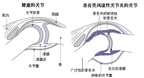 F(yng)(qing)ֱt(y)Ժ(li)L(fng)񲡰l(f)ʾD.jpg