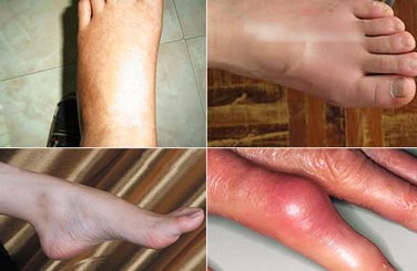貴陽強直醫(yī)院手足關節(jié)痛風臨床癥狀.jpg
