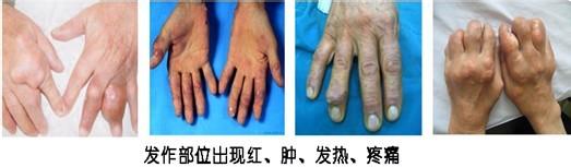 貴陽(yáng)強(qiáng)直醫(yī)院手部痛風(fēng)癥狀.jpg