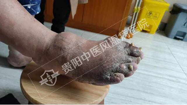 痛風(fēng)性關(guān)節(jié)炎導(dǎo)致無(wú)法正常穿鞋2.jpg